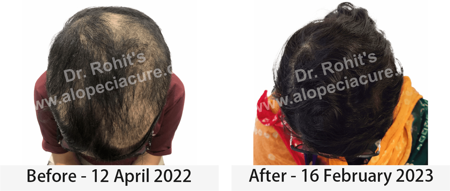 hair loss treatment